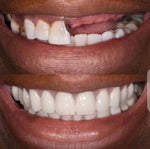 Charger l'image dans la galerie, Prothèse dentaire